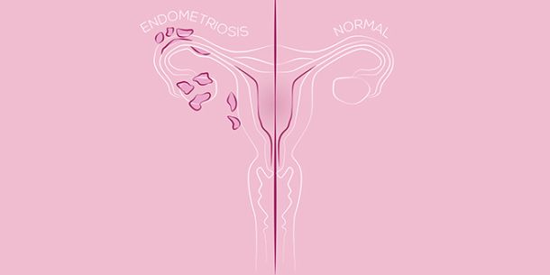 maternica endometrioza